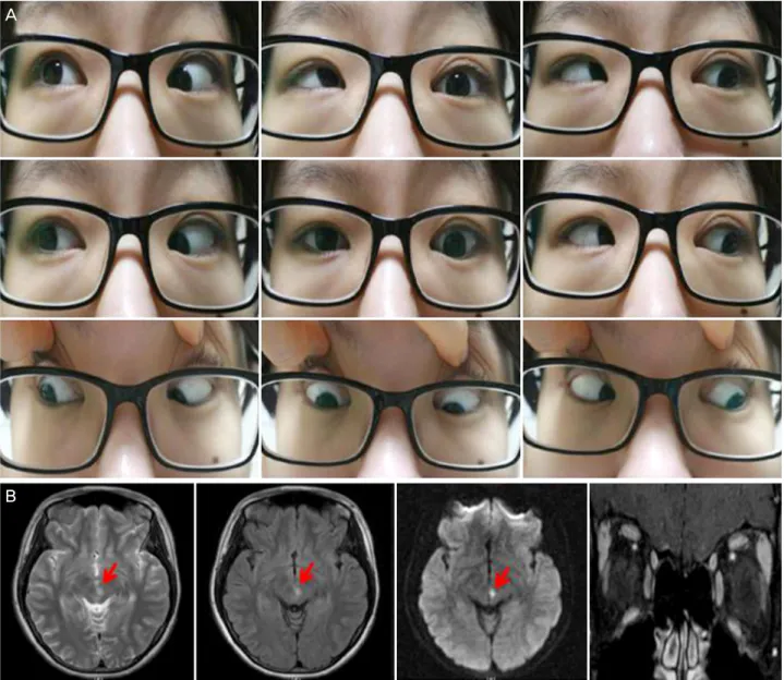 Figure 2. The clinical manifestation and imaging five months after the initial presentation