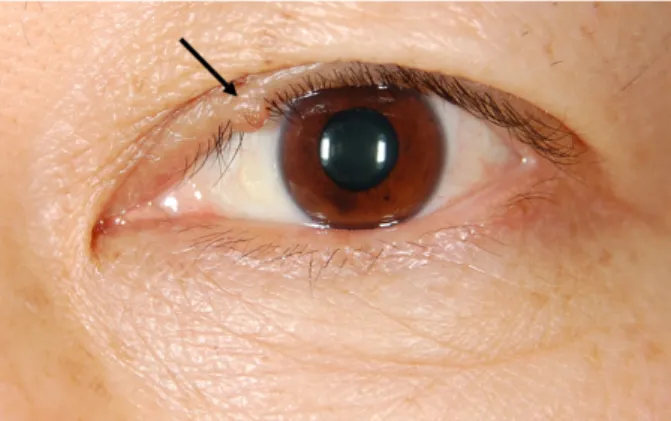 Figure 1. Compound nevus. A compound nevus of the upper  eyelid margin in a 48-year-old woman (black arrow).