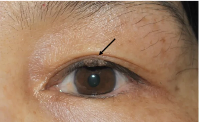 Figure 5. Epidermal cyst. A smooth, soft, yellowish ruptured  epidermal cyst located on the upper eyelid in a 27-year-old  man (black arrow)
