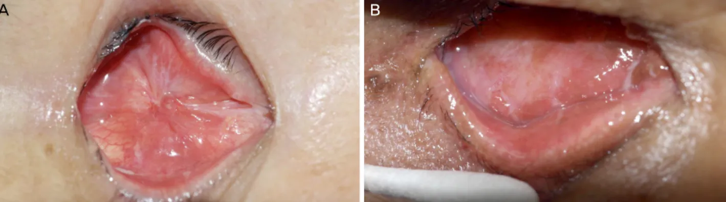 Figure 1. Pre- and postoperative photo. (A) Postoperative photograph taken 11 days after the operation, conjunctival fornix re- re-construction, upper