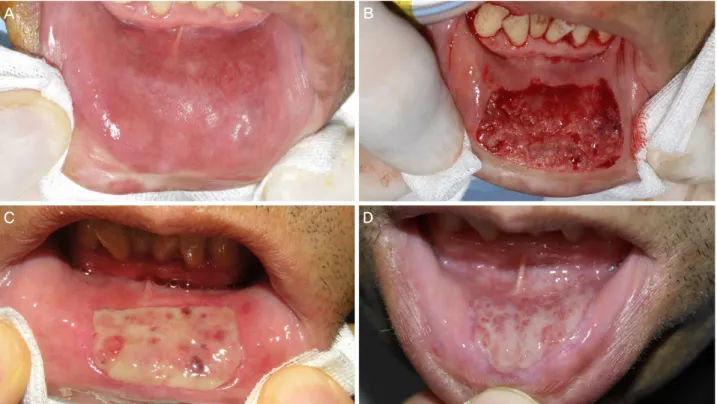 Figure 2. Lower lip donor site. (A) Preoperative photograph. (B) Intraoperative photograph