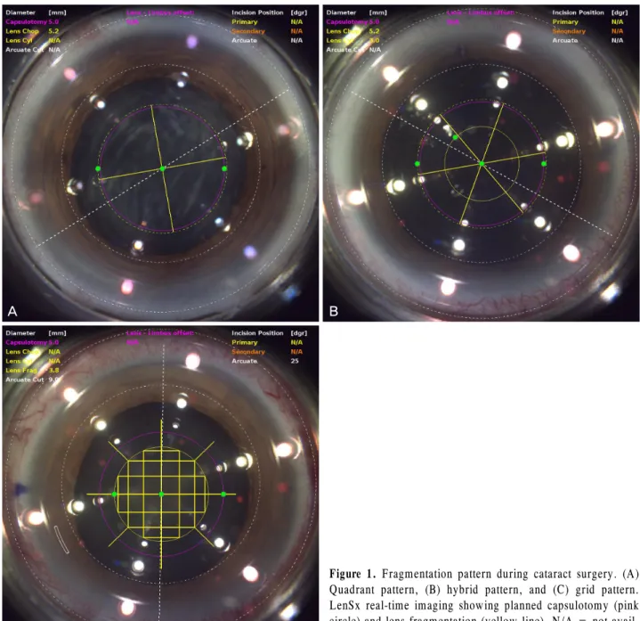 Figure 1. Fragmentation pattern during cataract surgery. (A)  Quadrant pattern, (B) hybrid pattern, and (C) grid pattern