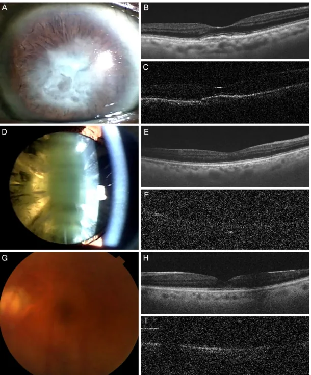 Figure 2. Representative cases of ocular media opacity. (A-C) A case of corneal opacity