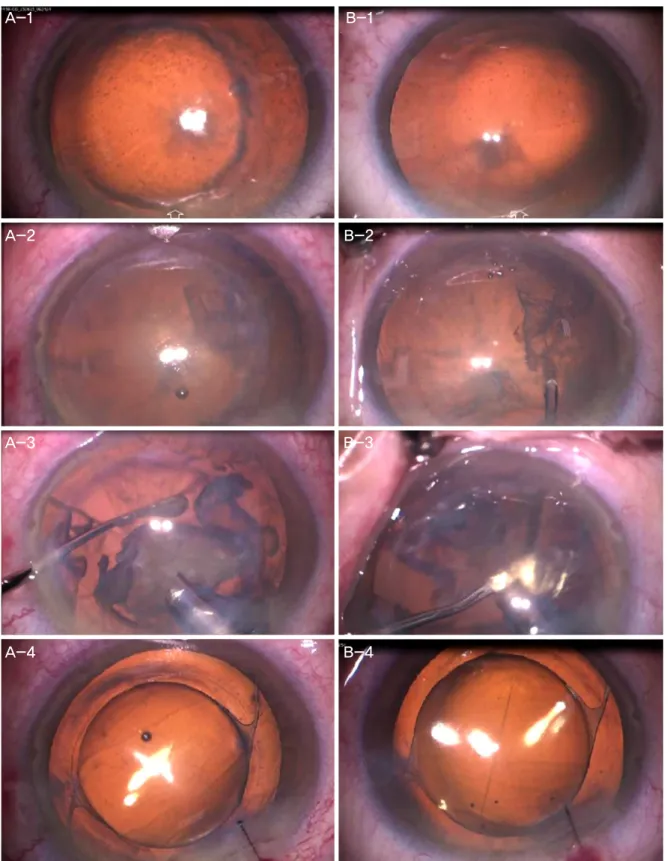 Figure 2. Intraoperative microscopic view of the both eyes during cataract surgery. (A) Right eye