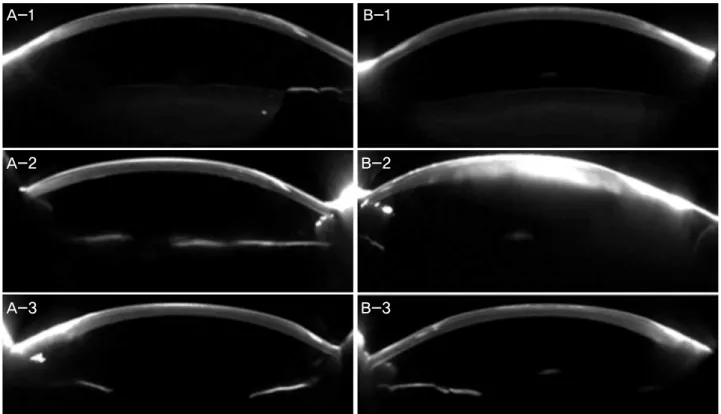 Figure 3. Pentacam® Scheimpflug images of both eyes. (A) Right eye. (B) Left eye. (A-1, B-1) Preoperative images: the epiker- epiker-atophakic lenticules are well attached to the corneal stroma in both eyes
