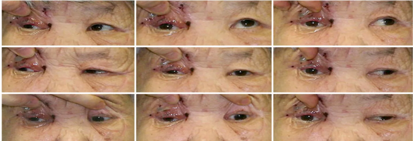 Figure 1. Nine cardinal gaze positions of case 1. Limitation of adduction, elevation and depression were present in the right eye (the  right eyelid was manually lifted due to ptosis).