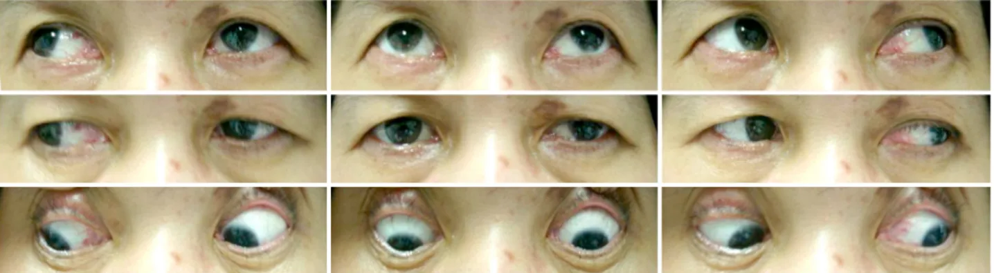 Figure 3. Nine cardinal gaze positions of case 2. Limitation of adduction and depression were present in the left eye.