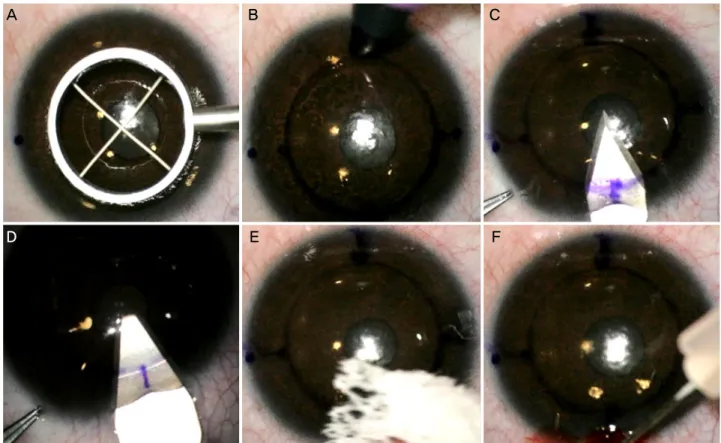 Figure 1. Astigmatic keratotomy. (A) Corneal marking using a ring marker with cross wires (7.5 mm)