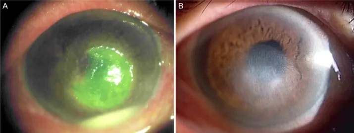 Figure 1. Slit-lamp photographs of Case 1. (A) At the initial visit, 4.5 × 4.5 mm sized epithelial defect with a 1.2 mm height  hypopyon