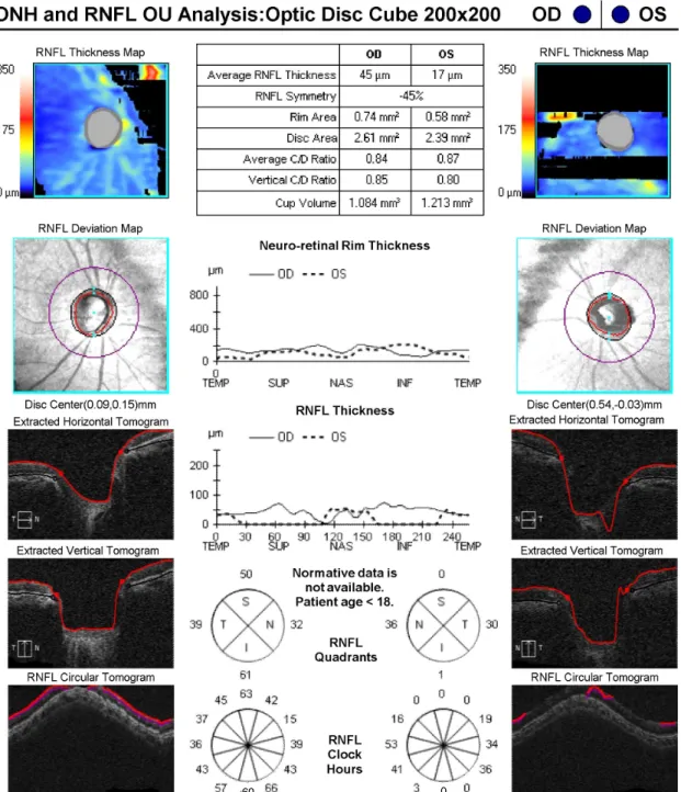 Figure 2. Neuro-retinal rim thinning and decreased retinal nerve fiber layer in both eyes measured by optical coherent tomography