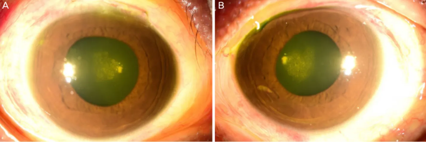 Figure 3.  Anterior segment photograph after treated with systemic steroid. Posterior subcapsular cataract in the right eye (A) and  left eye (B)
