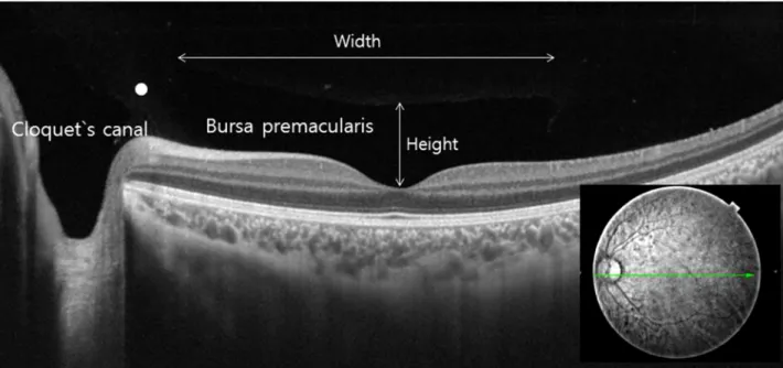 Figure 1. Evaluation of cortical vitreous using SS-OCT. An OCT 12-mm horizontal scan through the fovea in the left eye of a  57-year-old man