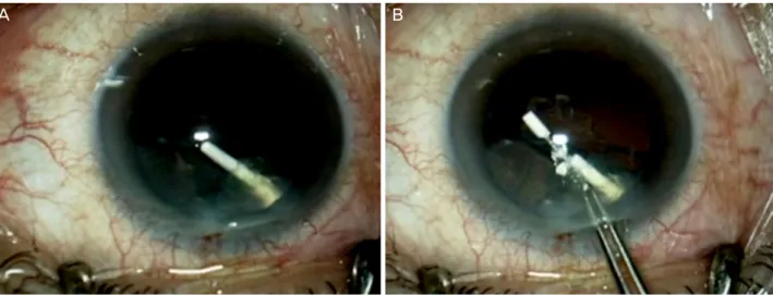 Figure 3. Intraoperative photograph showing the dexamethasone  implant in the lens.