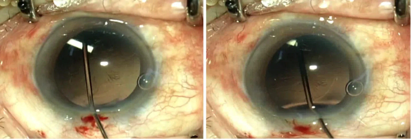 Figure 5. Intraoperative photograph when the dexamethasone implant was pushed into the vitreous cavity.