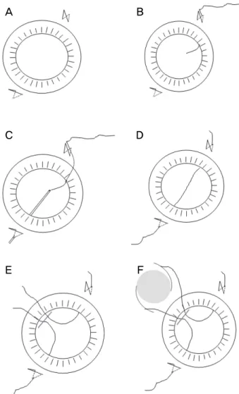 Figure 1. Steps of two-haptic transscleral fixation of intra- intra-ocular lens (IOL)