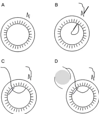 Figure 2. Steps of one haptic transscleral fixation of intra- intra-ocular lens (IOL)