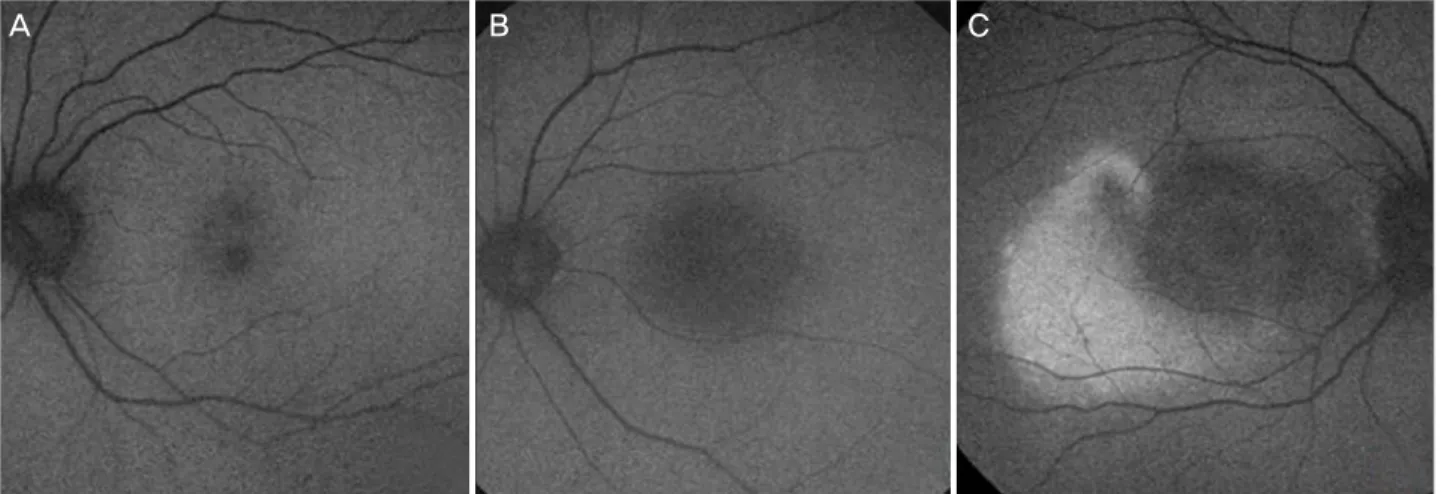 Figure 1. Fundus autofluorescence image classification compared to background autofluorescence