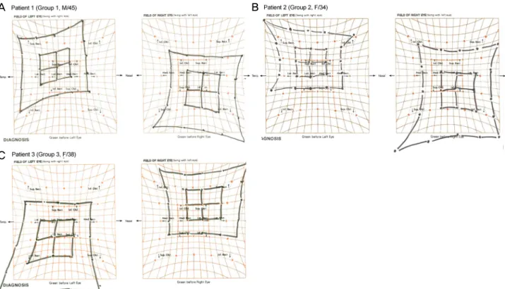 Figure 1. Preoperative Hess screening tests of patients. (A) Group 1. A 45-year-old male with 18 PD exotropia and 30 PD left hyper- hyper-tropia at primary position