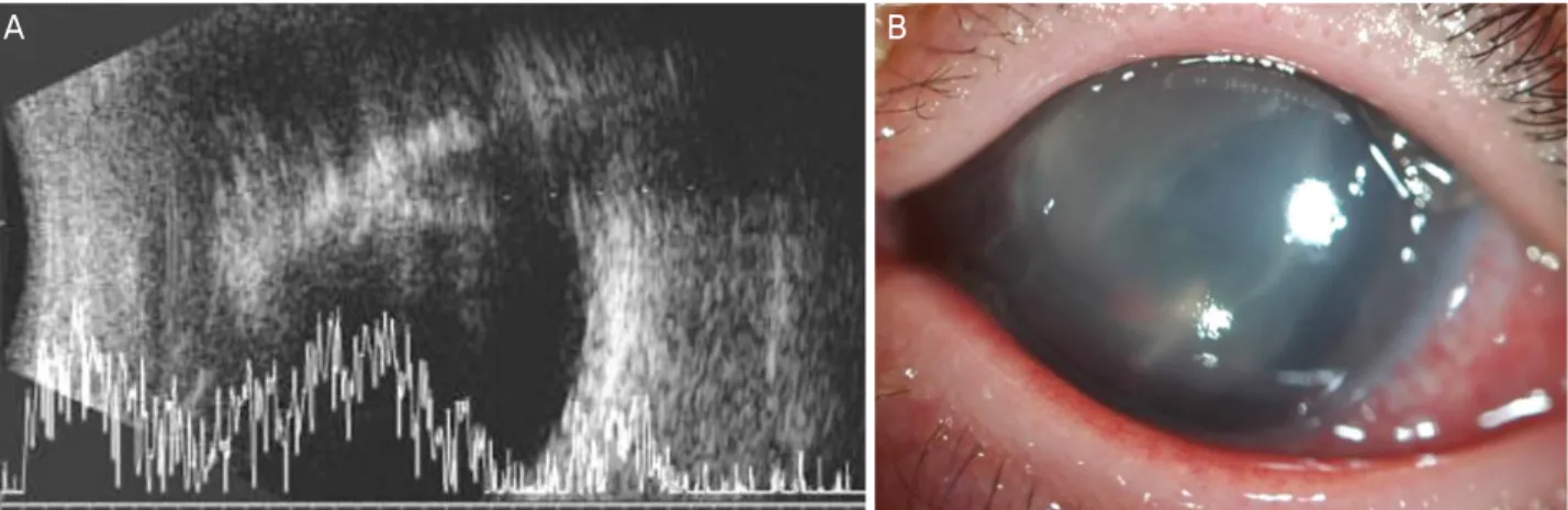 Figure 2. Imaging of patient 3. (A) Initial B-scan shows no definite mass-like lesion or calcification in the left eye