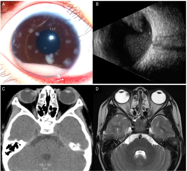 Figure 3. Imaging of patient 5. (A) Initial anterior segment photograph of the right eye shows hypopyon and whitish spots on the sur- sur-face of the iris
