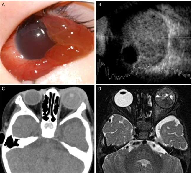 Figure 4. Imaging of patient 6. (A) Anterior segment photograph of the left eye at the initial visit shows diffuse chemosis and  hyphema