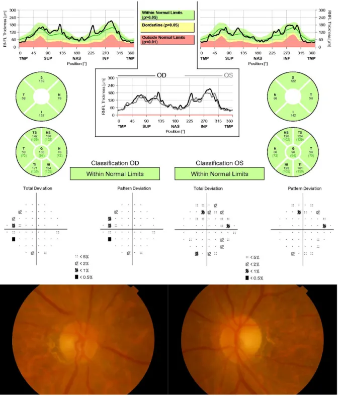 Figure 1. Representative figure of a 77-year-old male with visual acuity of 14/20 in the right eye and 18/20 in the left eye, showing  a mild decrease in the retinal nerve fiber layer (RNFL) thickness