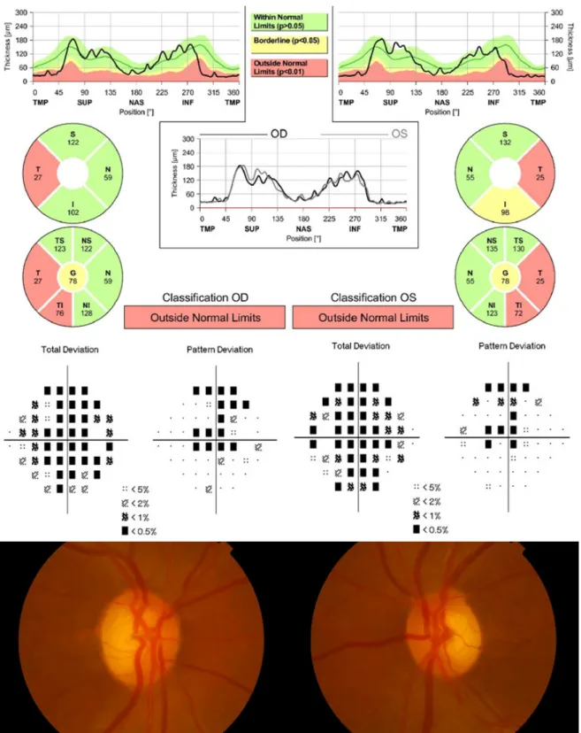 Figure 2. Representative figure of a 60-year-old female with a visual acuity of 3/20 in the right eye and 6/20 in the left eye, showing  a severe decrease in the retinal nerve fiber layer (RNFL) thickness