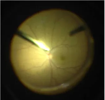 Figure 2. Intraoperative fundus finding. At the end of vi- vi-trectomy, there was no inflammation or retinal hemorrhages  on her left fundus.