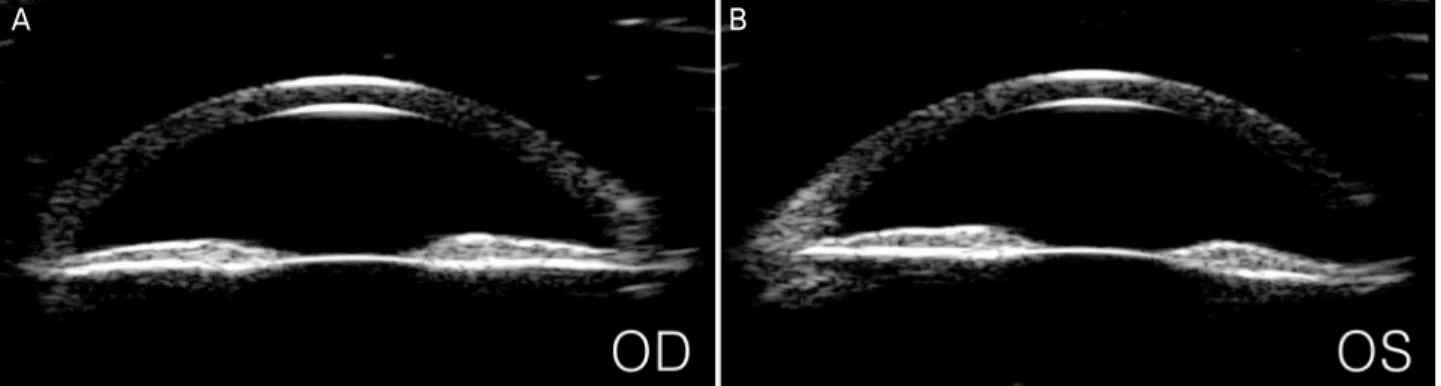 Figure 1. Ultrasound biomicroscopy examination. There are no changes of location of ciliary body and edema in both eyes (A, B)