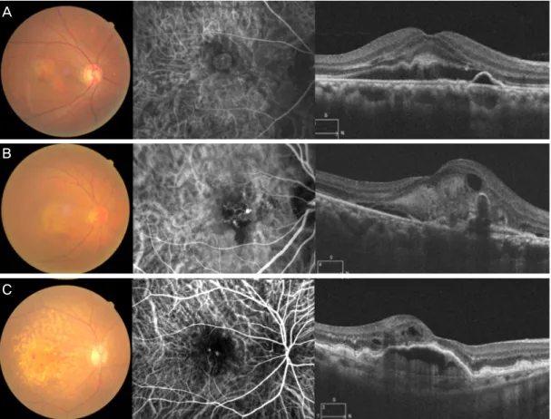 Figure 1. Representative images of three subtypes of exudative age-related macular degeneration (AMD)