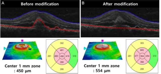 Figure 3. Central macular thickness modification using a built-in segmentation-modifying tool of optical coherence tomography
