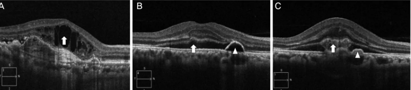 Figure 4. Morphologic features of optical coherence tomography related to age-related macular degeneration