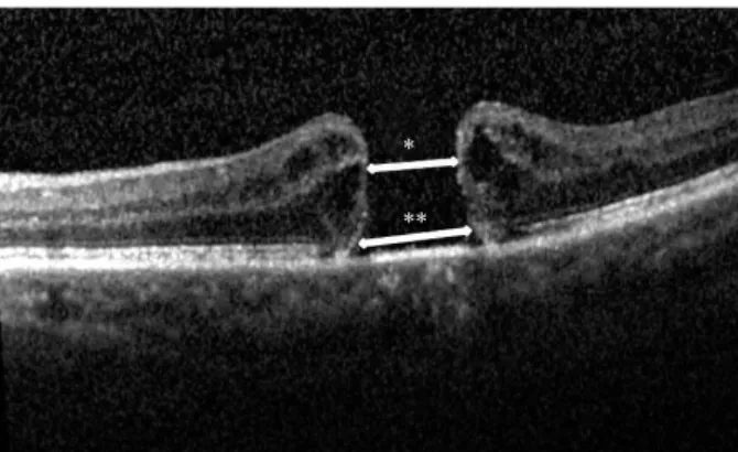 Figure 1. Size parameters of macular hole on spectral domain  optical coherence tomography