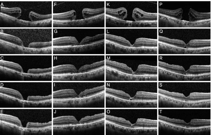 Figure 2. Spectral domain optical coherence tomography (SD-OCT) serial images obtained from patients during 12 months fol- fol-low-up period