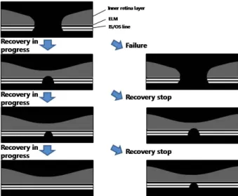 Figure 3. Schematic drawing of the various macular hole heal- heal-ing process after surgery