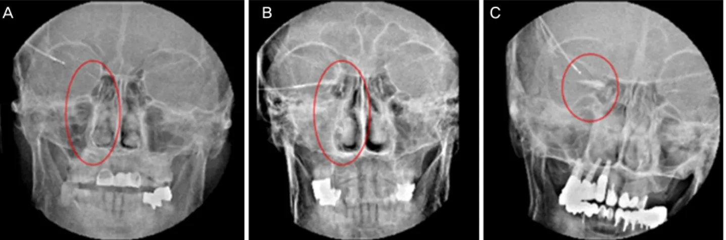 Figure 1. Classification of nasolacrimal duct stenosis according to dacryocystography finding