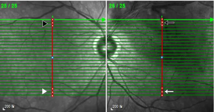Figure 1. Method of measuring the choroidal thickness. Cross sectional image centered in macula (blue circle) was taken in the en- en-hanced depth imaging mode with suprerior branch retinal vein occlusion (BRVO) in left eye