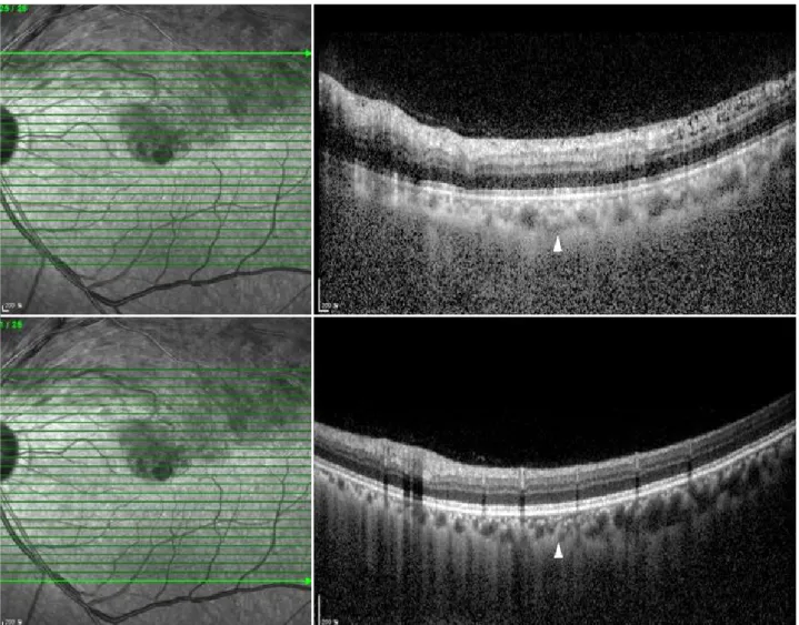 Figure 2. Method of measuring the choroidal thickness. Cross sectional image centered in macula taken in the enhanced depth imag- imag-ing mode with suprerior branch retinal vein occlusion in left eye