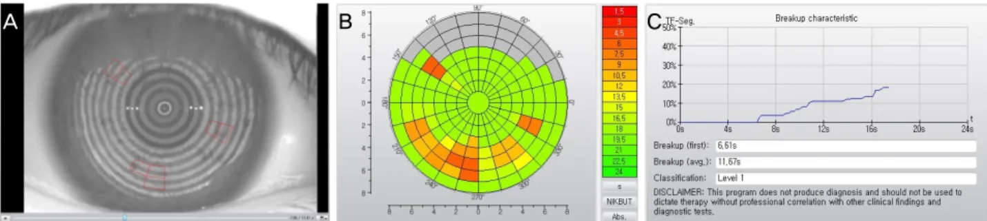 Figure 1. Representative image of non-invasive keratograph tear film break-up time (NIK-BUT) using Oculus Keratograph 4  (Oculus, Wetzler, Germany)