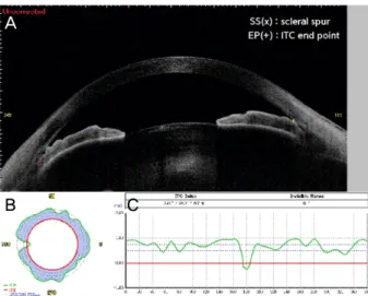 Figure 2. Cross-section image of angle structure illustrating  angle parameters. (A) Angle opening distance at 500 μm from  scleral spur (AOD 500 ) and trabecular-iris angle 500 (TIA 500 )