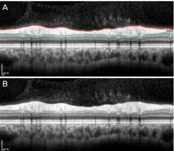 Figure 1. Optical coherence tomography. (A) Normalperipapillary  retinal nerve fiber layer thickness (RNFL) profile automatically  seg-mented in Spectralis optical coherence tomography