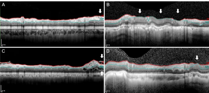 Figure 2. Examples of 4 segmentation error types in Spectralis™ imaging for retinal nerve fiber layer thickness