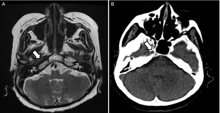 Figure 3. Magnetic resonance imaging (MRI) and computed tomography (CT). (A) MRI and (B) CT of the skull base showing a car- car-otid canal on the right (arrows), but absent on the left.