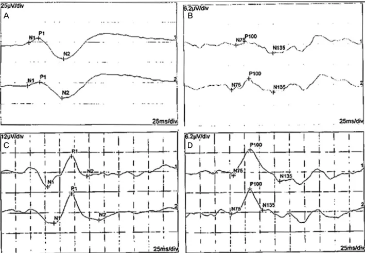 Figure 2. Serial changes of flash visual evoked potential (VEP) and pattern VEP in both eyes