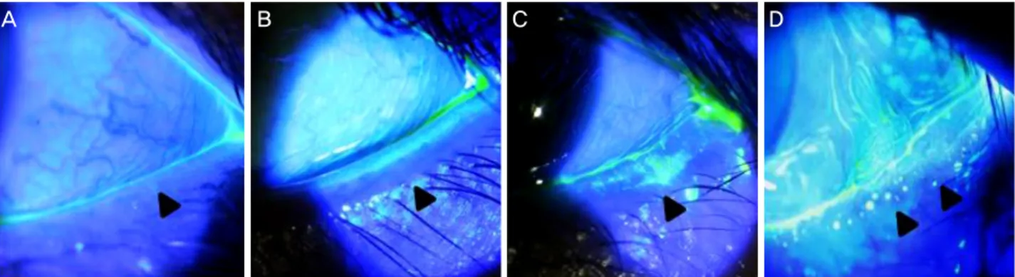 Figure 1. Blepharitis–Obstructive meibomian gland dysfunction Grading. This is slit lamp photographs of clinical scale for blephar- blephar-itis grading (especially temporal side)