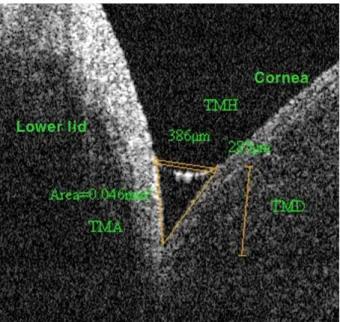 Figure 1. Optical coherence tomography image of the lower  tear meniscus showing the tear meniscus height, depth and  area