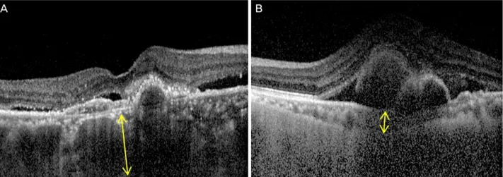 Figure 1. Choroidal thickness was measured manually using a caliper that is provided in the optical coherence tomography device
