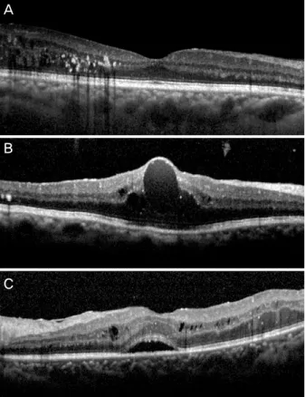 Figure 1. Morphologic patterns of diabetic macular edema by  optical coherence tomography