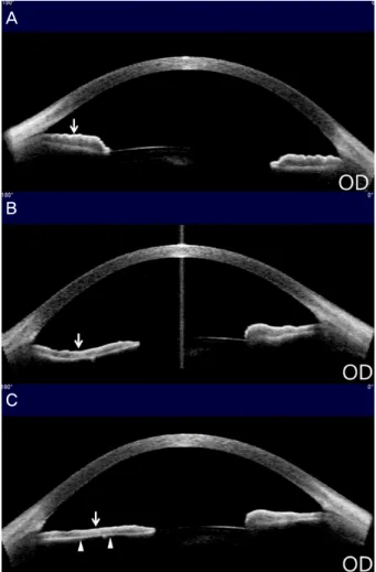Figure 1. Changes in the iris contour of patient's right eye. 