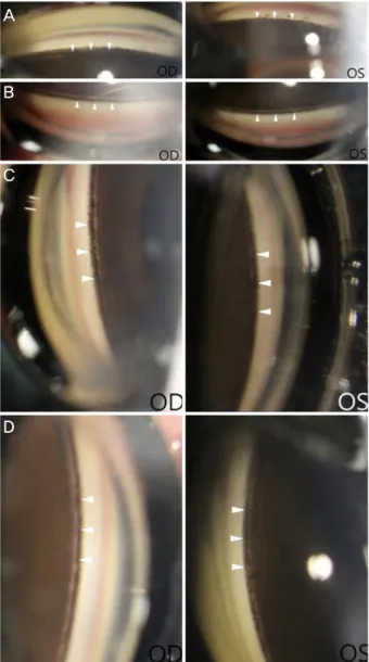Figure 2. Gonioscopy showing open angles with 3 degrees of  pigment deposition on the trabecular meshwork (white  arrow-heads) in the right eye and 2 degrees of pigment deposition in  the left eye at 4 weeks after laser peripheral iridotomy (LPI) on  the r